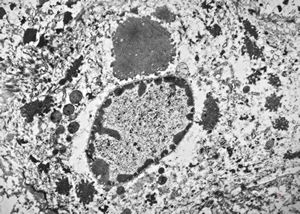 F, 11y. | ichthyosis hystrix type Curth-Macklin